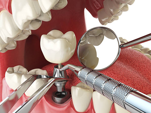 Best Dental Abscess Treatment in West Deland, FL